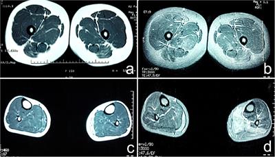 SCN4A p.R675Q Mutation Leading to Normokalemic Periodic Paralysis: A Family Report and Literature Review